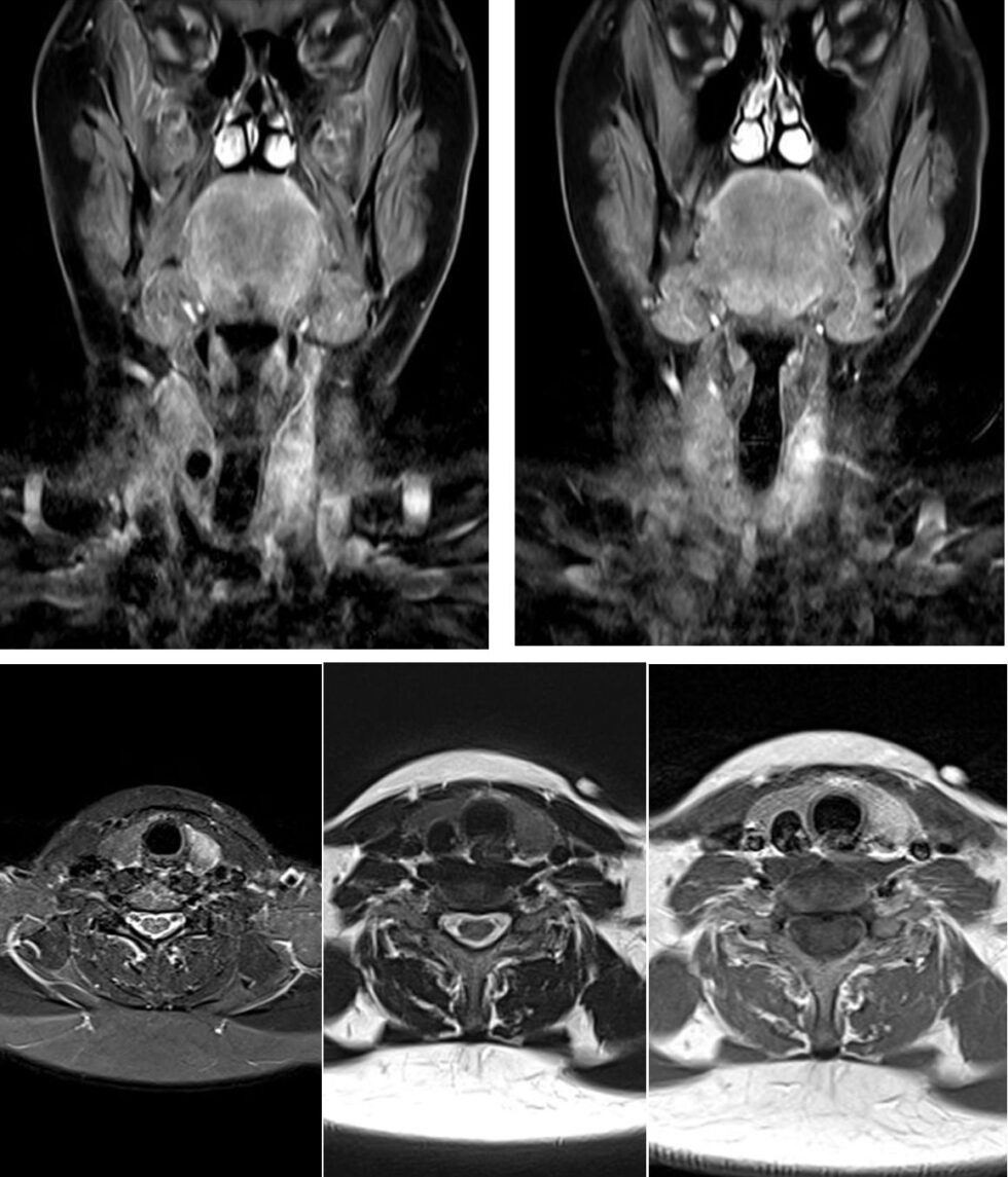 Thyreoiditis De Quervain | Dr. Schützler - Schilddruese online